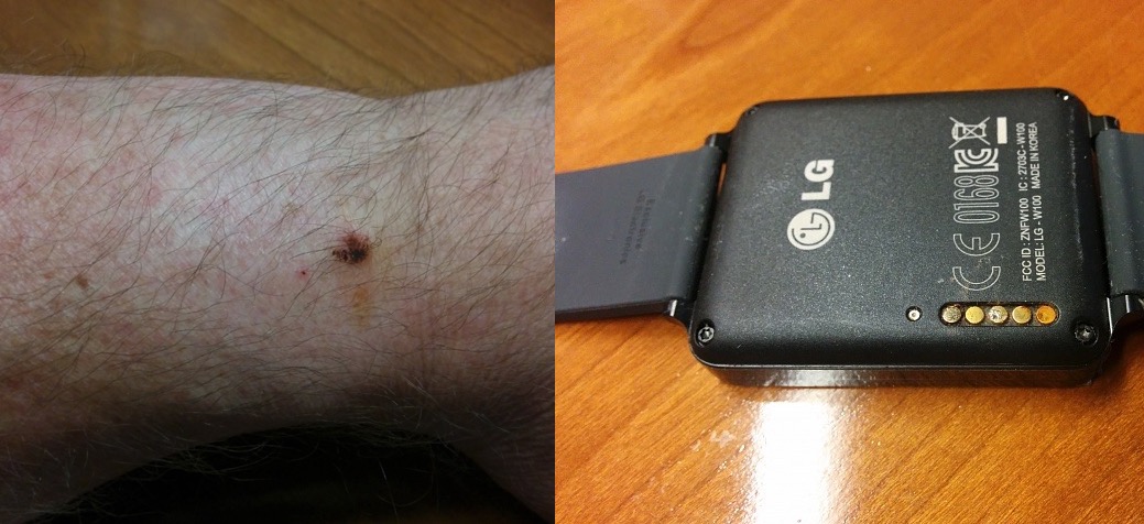 LG G Watch : des problèmes de corrosion et de brûlure